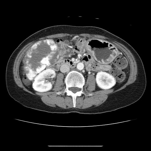 File:Cavernous hepatic hemangioma (Radiopaedia 75441-86667 B 56).jpg