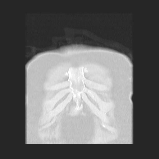 File:Cavitating pulmonary metastases (Radiopaedia 89545-106544 Coronal lung window 2).jpg