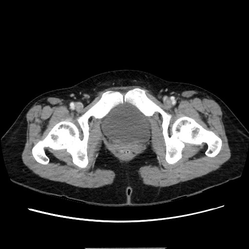 Cecal adenocarcinoma (Radiopaedia 75909-87331 A 86).jpg