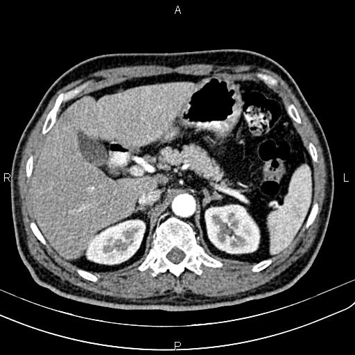 Cecal cancer with appendiceal mucocele (Radiopaedia 91080-108651 A 68).jpg