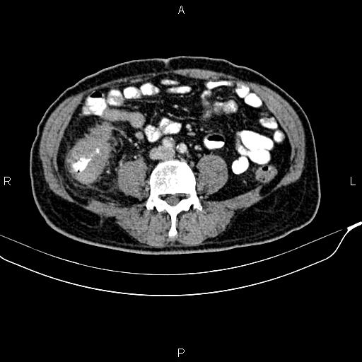 Cecal cancer with appendiceal mucocele (Radiopaedia 91080-108651 B 65).jpg