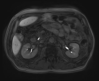 File:Cecal mass causing appendicitis (Radiopaedia 59207-66532 K 55).jpg