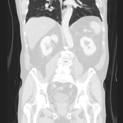 Cecal volvulus (Radiopaedia 75378-86620 Coronal lung window 90).jpg