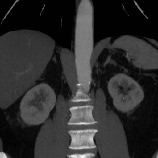 File:Celiac artery compression by the diaphragmatic crurae (Radiopaedia 31739-32666 B 9).jpg