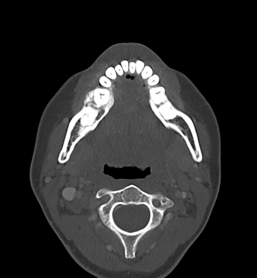 Cemento-ossifying fibroma (Radiopaedia 46243-50643 Axial bone window 41).png