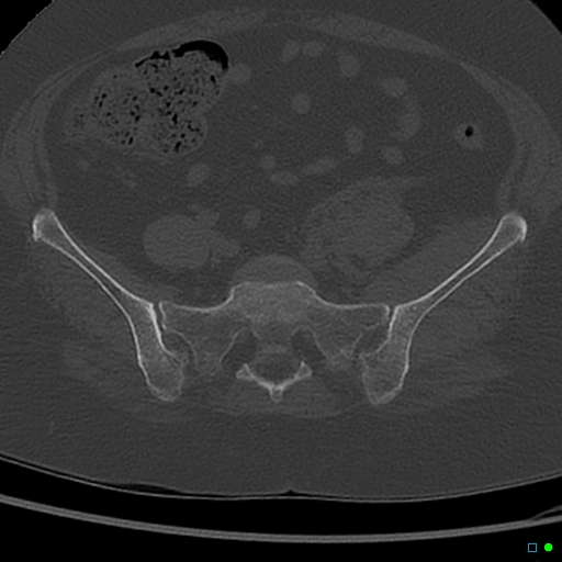 Central fracture-dislocation of the acetabulum (Radiopaedia 36578-38150 Axial bone window 11).jpg