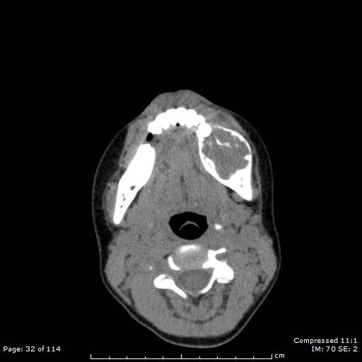 Central giant cell granuloma (Radiopaedia 45612-49754 Axial non-contrast 16).jpg