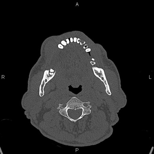 File:Central giant cell granuloma (Radiopaedia 83346-97761 Axial bone window 3).jpg