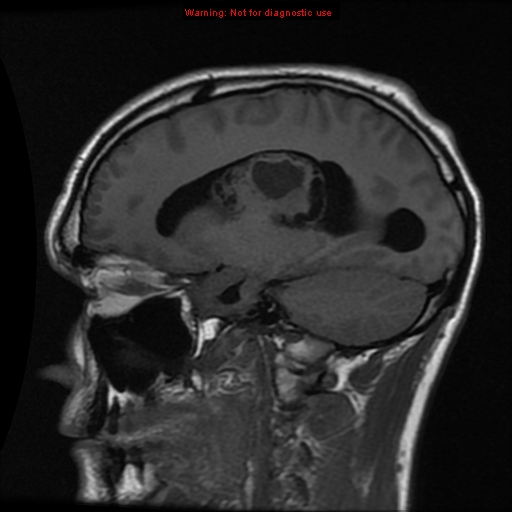 File:Central neurocytoma (Radiopaedia 13188-13206 Sagittal T1 12).jpg