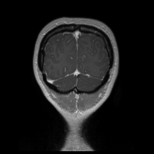 Central neurocytoma (Radiopaedia 37664-39557 Coronal T1 C+ 10).png
