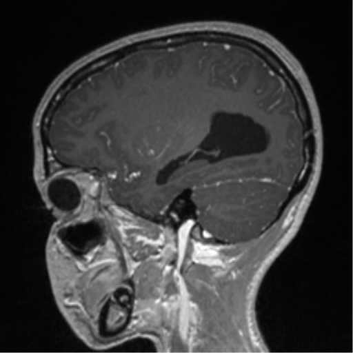 Central neurocytoma (Radiopaedia 37664-39557 Sagittal T1 C+ 30).png