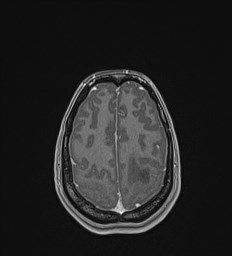 File:Central neurocytoma (Radiopaedia 84497-99872 Axial T1 C+ 126).jpg