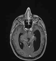 Central neurocytoma (Radiopaedia 84497-99872 Axial T1 C+ 62).jpg