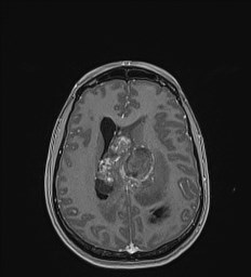 Central neurocytoma (Radiopaedia 84497-99872 Axial T1 C+ 98).jpg