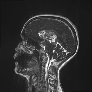 Central neurocytoma (Radiopaedia 84497-99872 Sagittal CISS 36).jpg