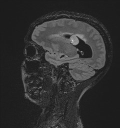 File:Central neurocytoma (Radiopaedia 84497-99872 Sagittal Flair + Gd 53).jpg