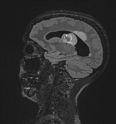File:Central neurocytoma (Radiopaedia 84497-99872 Sagittal Flair + Gd 57).jpg