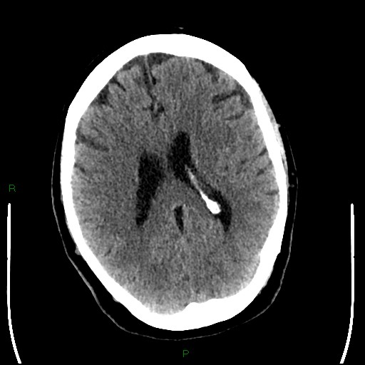 Cerebellar abscess (Radiopaedia 78135-90671 Axial non-contrast 66).jpg