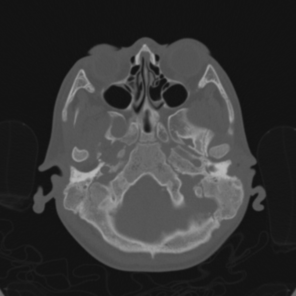 Cerebellar abscess secondary to mastoiditis (Radiopaedia 26284-26413 Axial bone window 33).jpg