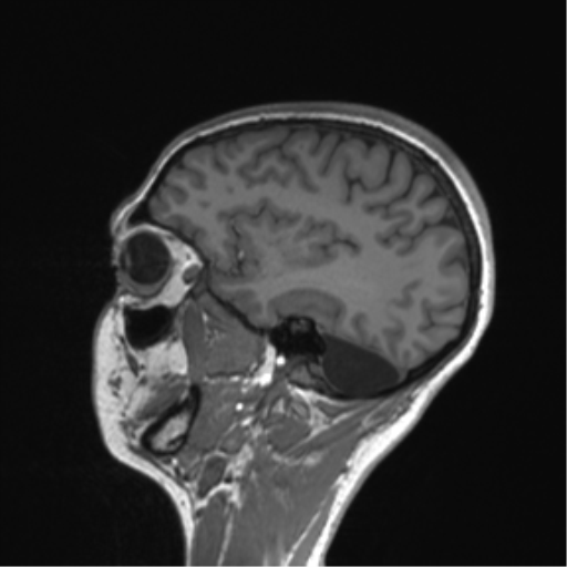 Cerebellar agenesis with hypoplastic pons (pontocerebellar hypoplasia) (Radiopaedia 57224-64138 Sagittal T1 23).png