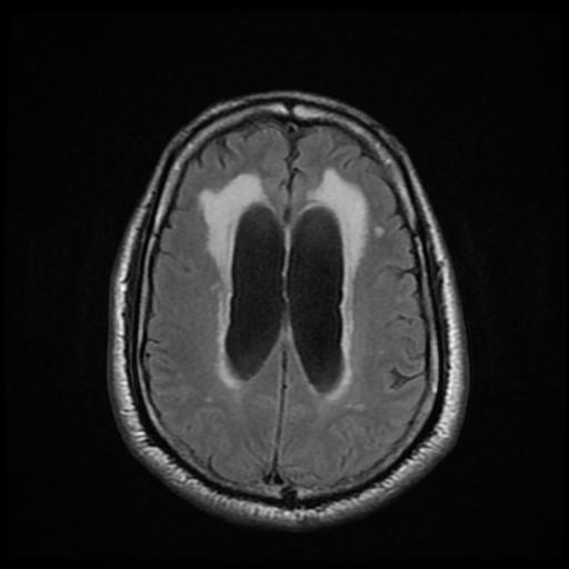 File:Cerebellar hemangioblastoma (Radiopaedia 88055-104622 Axial FLAIR 18).jpg