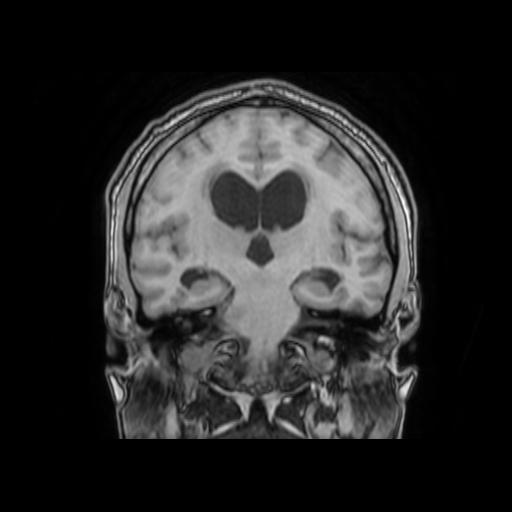 File:Cerebellar hemangioblastoma (Radiopaedia 88055-104622 Coronal T1 20).jpg