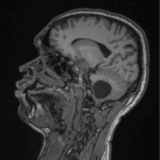 Cerebellar hemangioblastomas and pituitary adenoma (Radiopaedia 85490-101176 Sagittal T1 60).png