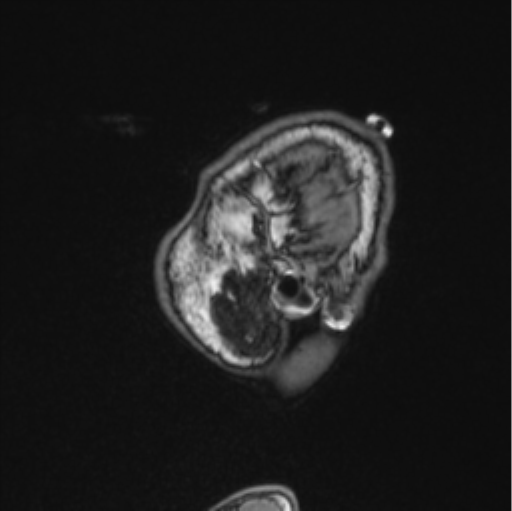 Cerebellar hemangioblastomas and pituitary adenoma (Radiopaedia 85490-101176 Sagittal T1 87).png