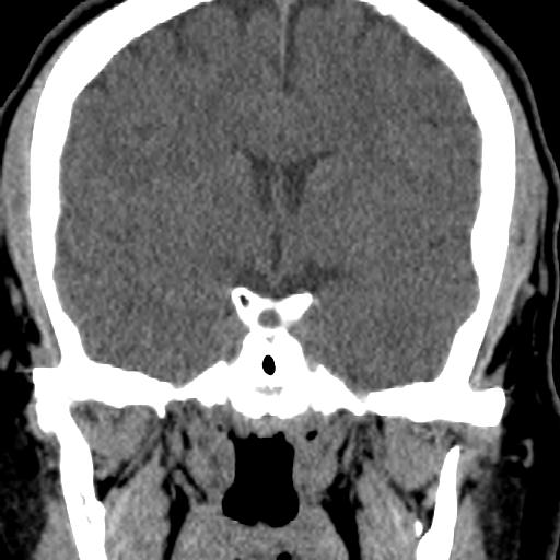 Cerebellar infarction (Radiopaedia 16625-16327 Coronal non-contrast 2).jpg