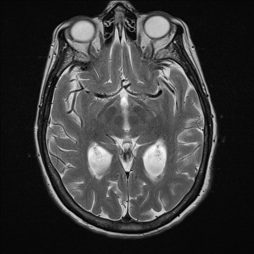 File:Cerebellar metastases (Radiopaedia 24038-24249 Axial T2 1).jpg