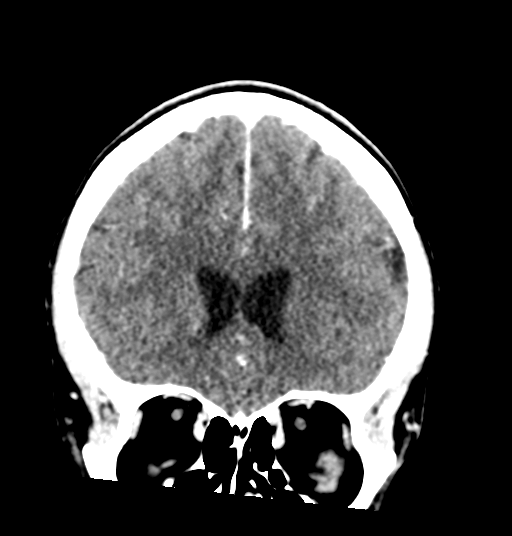 Cerebellar metastases - colorectal adenocarcinoma (Radiopaedia 40947-43652 Coronal C+ 31).png
