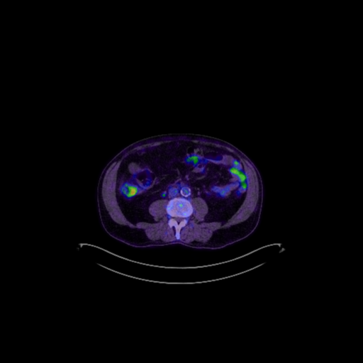 Cerebellar metastasis (Radiopaedia 33616-34719 A 71).png