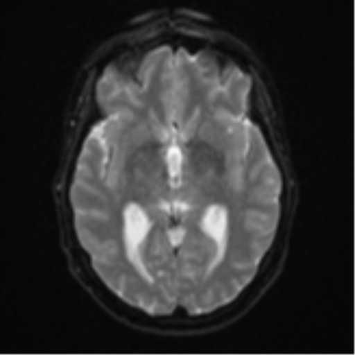 Cerebellar metastasis (Radiopaedia 51137-56765 Axial DWI 14).png