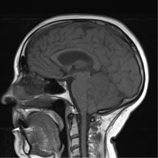 File:Cerebellar metastasis (Radiopaedia 54578-60810 Sagittal T1 11).png