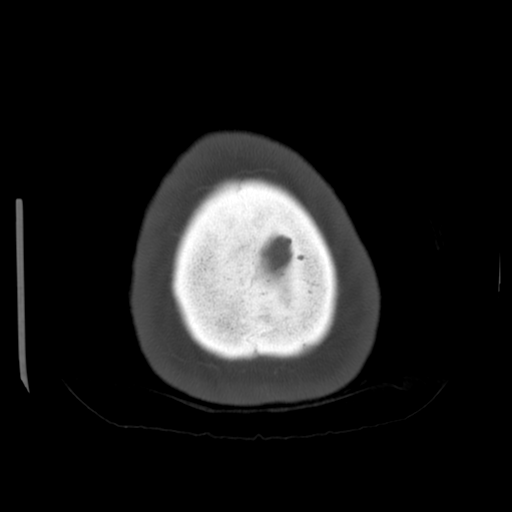 Cerebellar metastasis (cystic appearance) (Radiopaedia 41395-44258 Axial bone window 70).png
