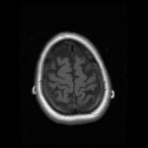 File:Cerebellar metastasis (cystic appearance) (Radiopaedia 41395-44262 Axial T1 20).png