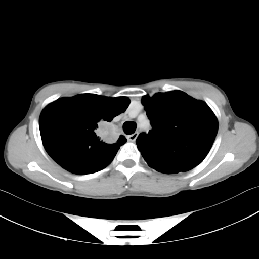 Cerebellar metastasis - adenocarcinoma lung (Radiopaedia 63184-71717 Axial C+ delayed 20).png