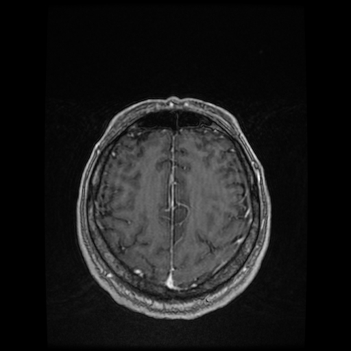 Cerebellar metastasis of pulmonary adenocarcinoma, cavernous venous malformation, and developmental venous anomaly (Radiopaedia 85827-101661 Axial T1 C+ 73).jpg
