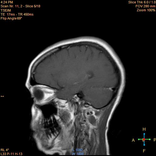 File:Cerebellopontine angle meningioma (Radiopaedia 22488-22525 Sagittal T1 C+ 5).jpg
