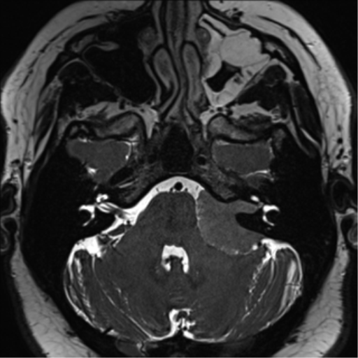 Cerebellopontine angle meningioma (Radiopaedia 48434-53348 Axial T2 Space 55).png