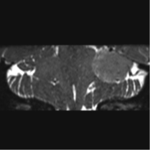 Cerebellopontine angle meningioma (Radiopaedia 48434-53348 Coronal T2 34).png