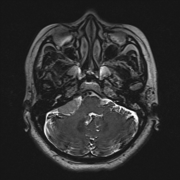 Cerebellopontine angle meningioma (Radiopaedia 53561-59591 Axial 3D volume T2 48).jpg