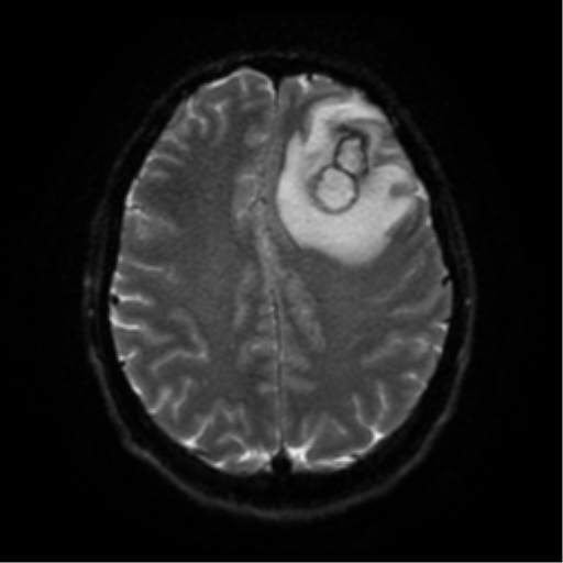 Cerebral abscess (Radiopaedia 57774-64740 Axial DWI 49).png