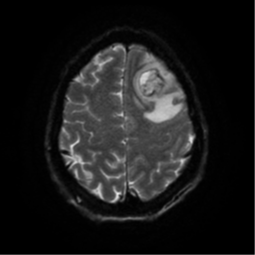 Cerebral abscess (Radiopaedia 57774-64740 Axial DWI 52).png