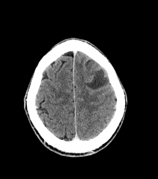 Cerebral abscess (Radiopaedia 57774-64741 Axial C+ delayed 51).png