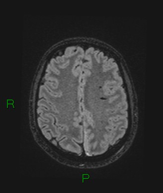 Cerebral abscess and subdural empyema (Radiopaedia 84436-99779 Axial FLAIR 29).jpg