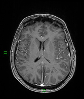 Cerebral abscess and subdural empyema (Radiopaedia 84436-99779 Axial T1 C+ 38).jpg