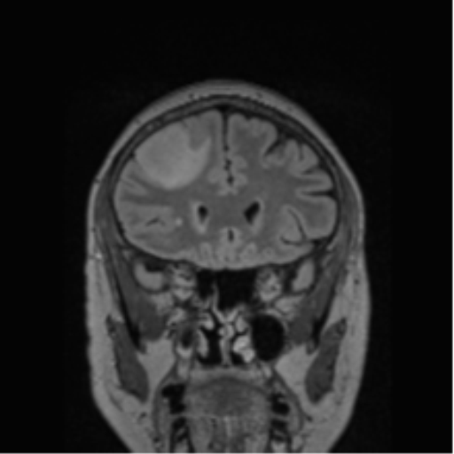Cerebral abscess from pulmonary arteriovenous malformation (Radiopaedia 86275-102291 Coronal FLAIR 64).png