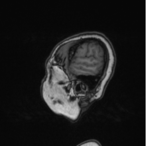 Cerebral abscess from pulmonary arteriovenous malformation (Radiopaedia 86275-102291 Sagittal T1 83).png