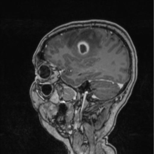 Cerebral abscess from pulmonary arteriovenous malformation (Radiopaedia 86275-102291 Sagittal T1 C+ 55).png